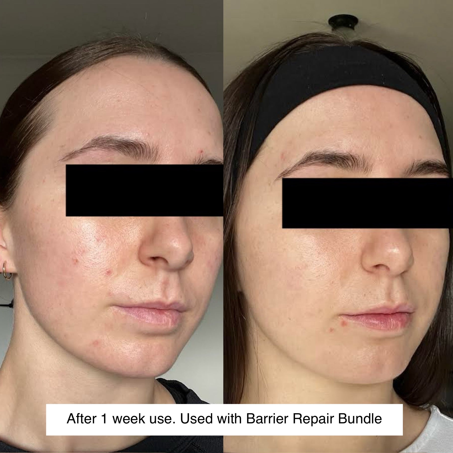 Barrier repair bundle | Tallow balm results | Natural Skincare