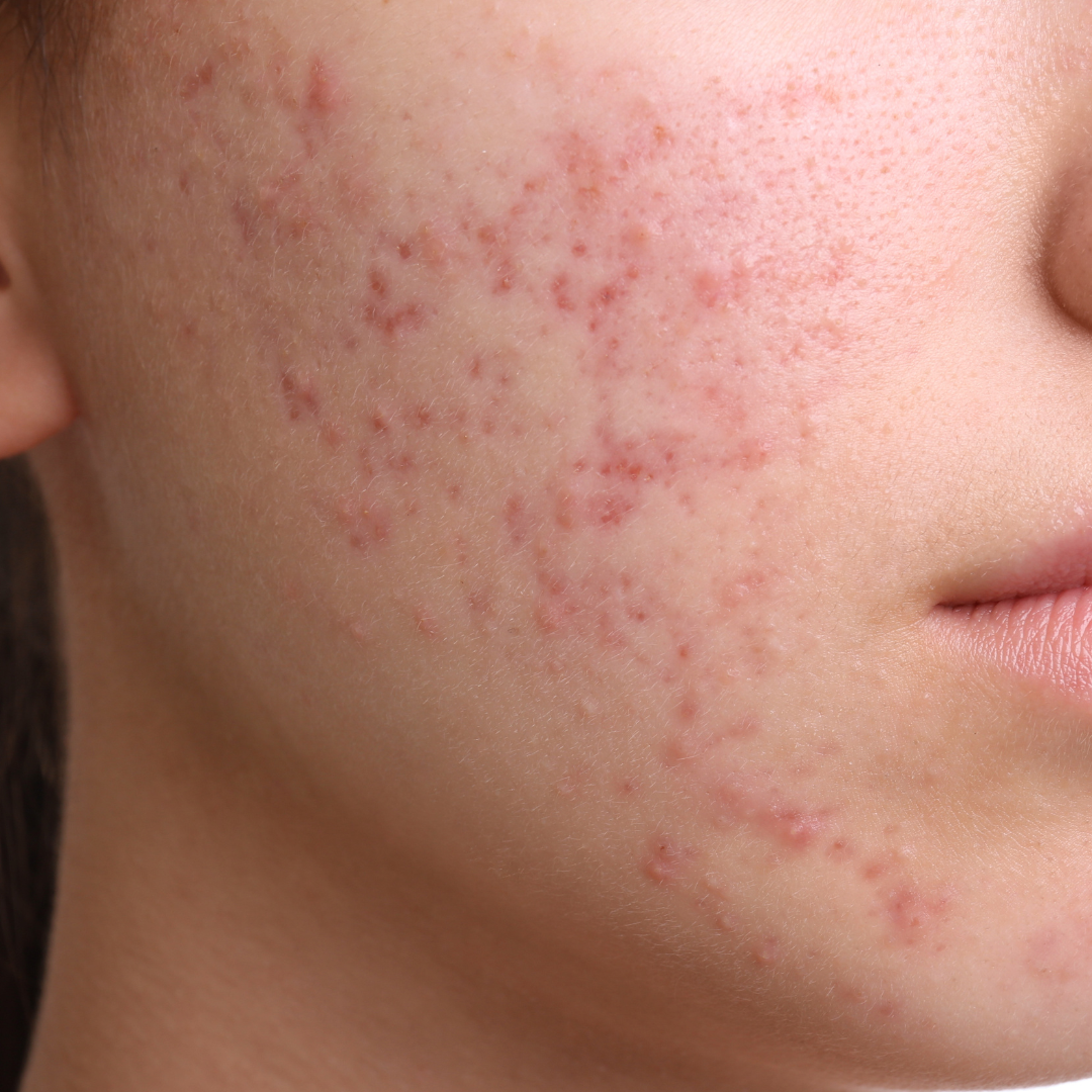 Acne prone skin